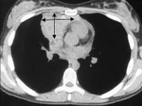 limfom mediastinal - cauze, simptome, diagnostic și tratament