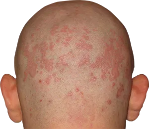 Tratamentul psoriazisului pe cap - 26 rețete! (Ore mai tarziu tensometrice, apa) Tratamentul psoriazisului pe cap - 26 rețete!