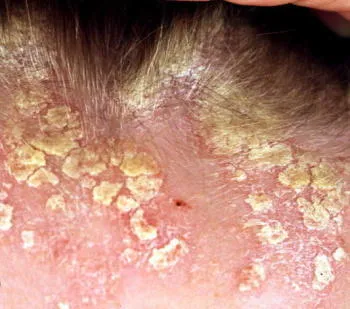 Tratamentul psoriazisului pe cap - 26 rețete! (Cap) Tratamentul psoriazisului pe cap - 26 rețete!