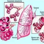 Tuse cu traheită traheidny cum pentru tratarea tusei (traheidny) Tuse cu traheită cum pentru tratarea tusei traheidny