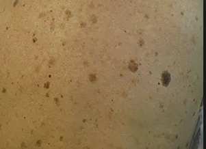 petele maronii de pe imaginea de piele, complicatii, tratament, excrescente pe piele