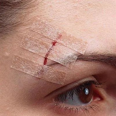 cusătură posibilele complicații cosmetice (complicații) cusătură cosmetice complicații posibile