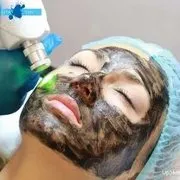 Face laser peeling - descrierea, contraindicații, fotografii, comentarii, preț (persoană) Laser Peelingul facial - descrierea, contraindicații, foto, comentarii, preturi