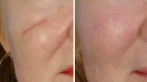 Peelingul cu laser și resurfacing feței - că este (cu laser co2 resurfacing facial) Peelingul cu laser și resurfacing feței - ceea ce este