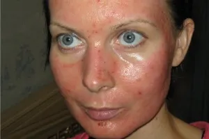 Peelingul cu laser și resurfacing feței - ceea ce este (facial dupa peeling cu laser) Peelingul cu laser și resurfacing feței - ceea ce este