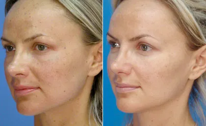 Face laser peeling - descrierea, contraindicații, foto, comentarii, preturi (contraindicații) Laser Peelingul facial - descrierea, contraindicații, foto, comentarii, preturi