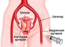 Tratamentul fibromului uterin, fara chirurgie (chirurgie) Tratamentul fibrom uterin, fara interventie chirurgicala
