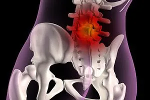 Tratamentul de hernie coloanei vertebrale lombare sacral conservatoare și operativă (hernia) Tratamentul de hernie spinal lombosacrală operative conservatoare și
