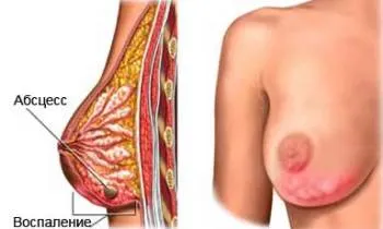 Tratamentul mastitei de remedii populare - 43 reteta!