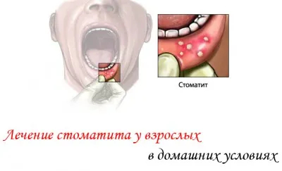 Cure pentru afte în gură la adulți care aleg