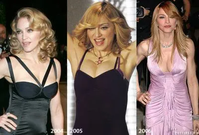 Chirurgie plastica Madonna - material plastic - Publisher - corp din plastic