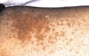 erupții cutanate maculopapulare
