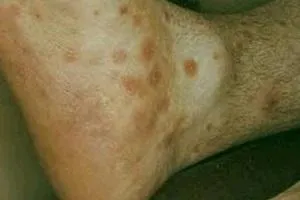 erupții cutanate maculopapulare