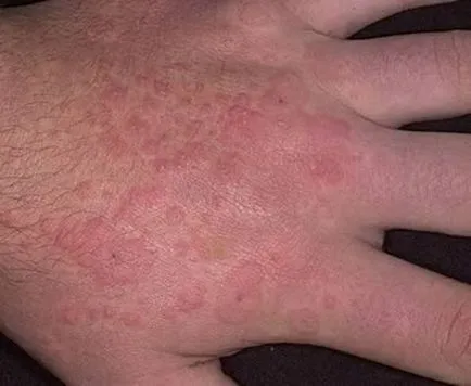 erupții cutanate maculopapulare - sfaturi și răspunsuri (erupții cutanate) erupții cutanate maculopapulare - sfaturi și răspunsuri