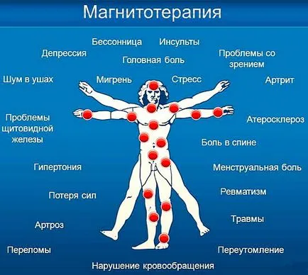 Terapia magnetică - indicații și contraindicații, magnet de tratament