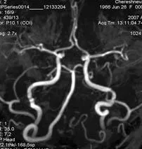 Expert RMN, angiografie MR în studiul arterelor cerebrale (IRM București) Expert RMN, angiografie MR în studiul arterelor cerebrale