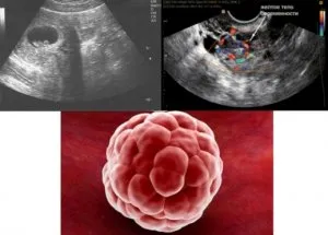 Este posibil să se confunde chist ovarian cu sarcina si modul de a determina cu acuratețe prezența tumorilor