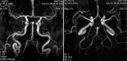 Expert RMN, angiografie MR în studiul arterelor cerebrale (IRM centre din București) Expert RMN, angiografie MR în studiul arterelor cerebrale