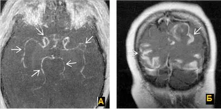 Expert RMN, angiografie MR în studiul arterelor cerebrale (artere) Expert RMN, angiografie MR în studiul arterelor cerebrale