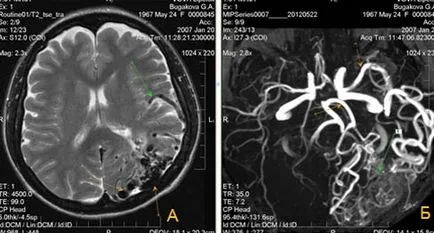 Expert RMN, angiografie MR în studiul arterelor cerebrale (MRA) Expert RMN, angiografie MR în studiul arterelor cerebrale