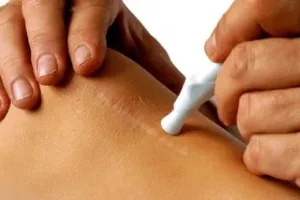 remedii populare pentru cicatrici pentru rezolutia si netezirea pielii
