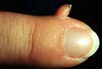 Excrescente pe piele