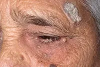 Excrescente pe piele