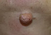 Excrescente pe piele