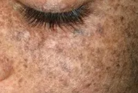 Excrescente pe piele