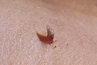 Excrescente pe piele