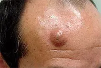 Excrescente pe piele