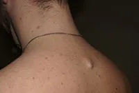 Excrescente pe piele