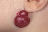 Excrescente pe piele