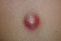 Excrescente pe piele