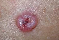 Excrescente pe piele