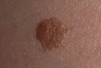 Excrescente pe piele