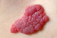 Excrescente pe piele