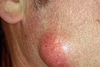 Excrescente pe piele