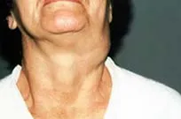 Excrescente pe piele