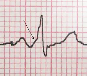 conducere intraventriculare, intraatriale