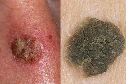 Excrescente pe piele, cu fotografii și nume (creșteri) Excrescente pe piele, cu fotografii și nume