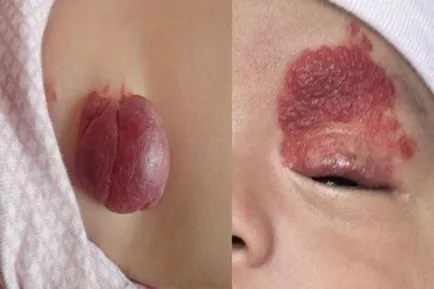 Excrescente pe piele, cu fotografii și nume (piele) Excrescente pe piele, cu fotografii și nume