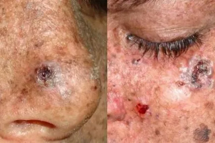 Excrescente pe piele cu fotografie și numele (pe piele) Excrescente pe piele, cu fotografii și nume
