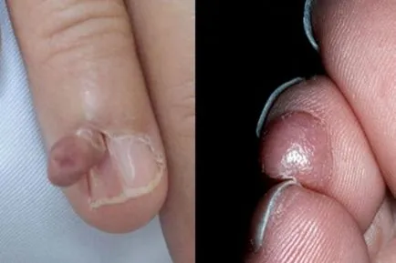 Excrescente pe piele, cu fotografii și nume (leziuni ale pielii, care) Excrescente pe piele, cu fotografii și nume