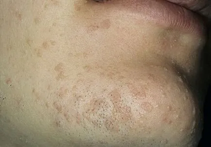 Creștere pe piele sub forma unei fotografii veruci, cum de a determina ce este - porumb, cosuri sau subcutanat (build-up sub forma de veruci) Creștere pe piele sub forma unei fotografii veruci, cum de a determina ceea ce este - porumb, cosuri sau subcutanat