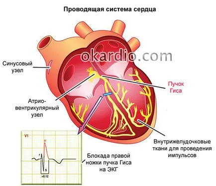 Perturbarea de conducere intraventriculare a inimii, care este
