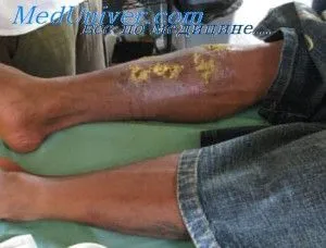 complicatii nespecifice si specifice ale infecțiilor