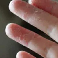 Oblazit pielea de pe degetele de la copii și adulți o iritație obișnuită sau boli periculoase (copii) piele Oblazit pe degetele de la copii și adulți o iritație obișnuită sau boli periculoase