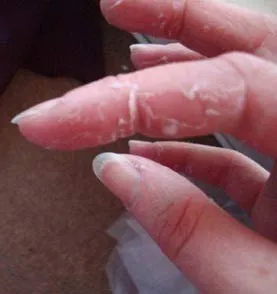 Oblazit pielea de pe degetele de la copii și adulți o iritație obișnuită sau boli periculoase (copii) piele Oblazit pe degetele de la copii și adulți o iritație obișnuită sau boli periculoase