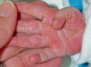 piele Oblazit pe degetele de la copii și adulți o iritație obișnuită sau boli periculoase (oblazit) piele Oblazit pe degetele de la copii și adulți o iritație obișnuită sau boli periculoase